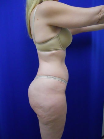 Zerona 338888
