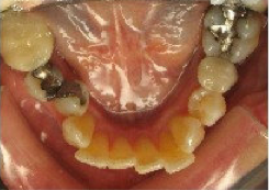 Invisalign Treatment 346613