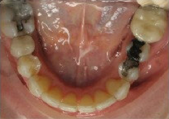 Invisalign Treatment 346613