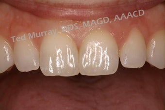 Cosmetic Bonding to close space 346955