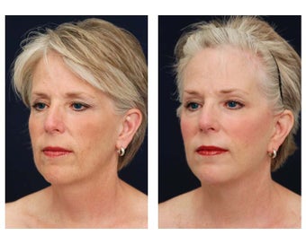 Neck Lift, Fat Grafting 347553