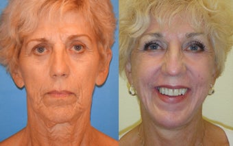Image Lift, Full Face Laser 351059