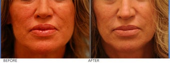Lip Reduction for Correction of Silicone 355074