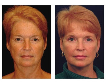 Lower Face and Neck Lift 355084