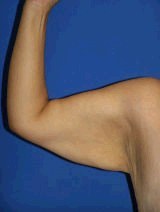 Arm Lift 356569