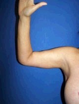Arm Lift 356569
