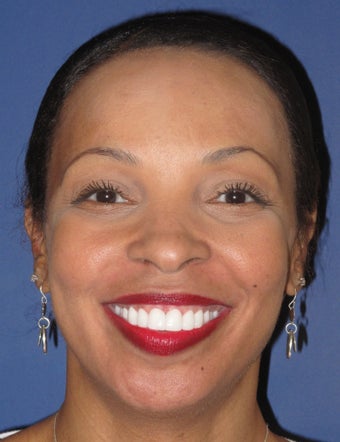 Veneers, gumlift 358197
