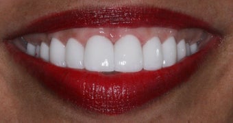 Veneers, gumlift after 358197