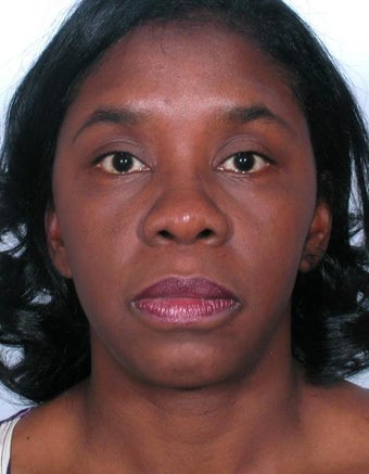 Rhinoplasty 358918