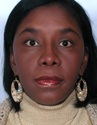 Rhinoplasty 358918