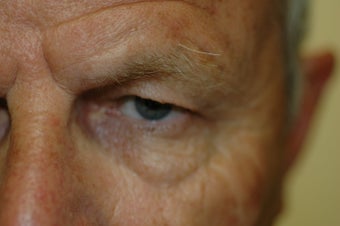 Brow lift 366293