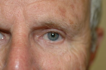 Brow lift 366293