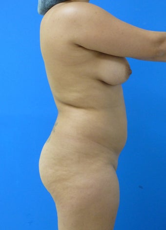 Brazilian Butt Lift 367406