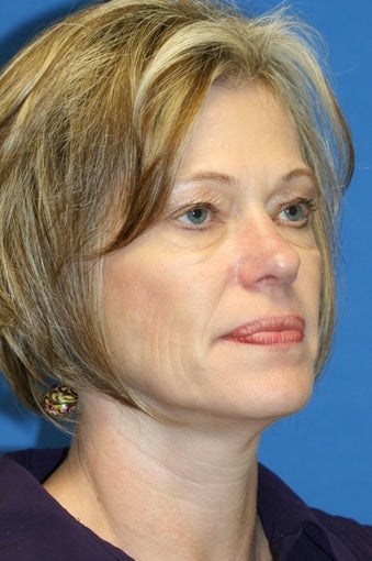 Eye Rejuvenation 367605