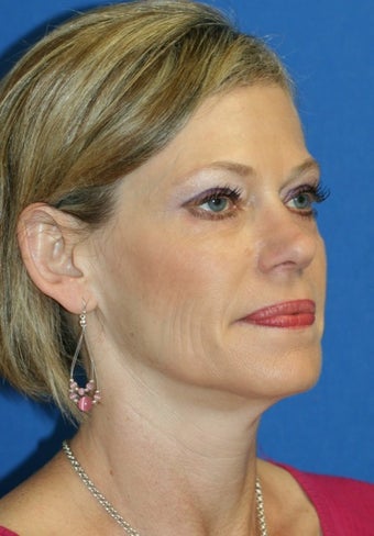 Eye Rejuvenation 367605