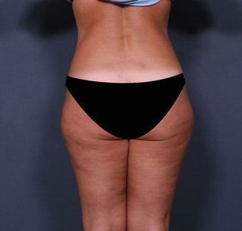 Liposuction 371112
