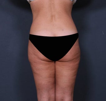 Liposuction 371112