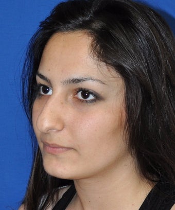 Rhinoplasty