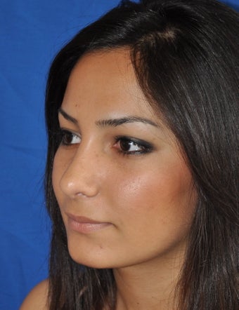 Rhinoplasty