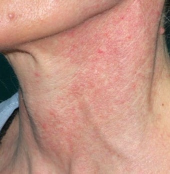 PDL treatment on neck 374533