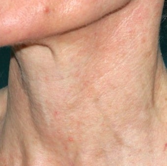 PDL treatment on neck 374533