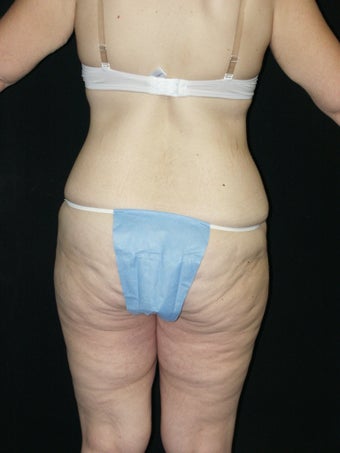Body Lift and Breast Implans 379786