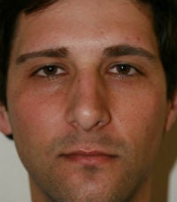 Rhinoplasty revision 380423