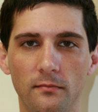 Rhinoplasty revision 380423