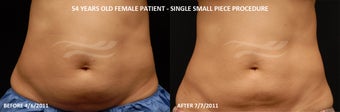 Body contouring 380980