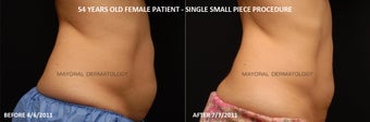 Body contouring 380980