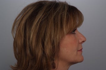 Ulthera 383132