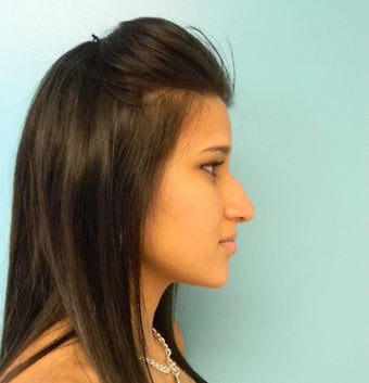 Rhinoplasty- Nose Job 390228