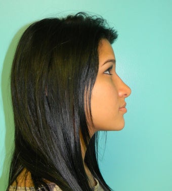 Rhinoplasty- Nose Job 390228