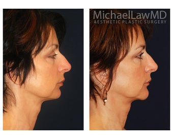 Chin Liposuction 391524