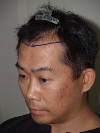 Hair Transplant 392977