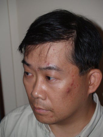 Hair Transplant 392977