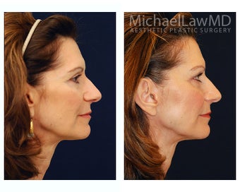 Facial Rejuvenation 393311