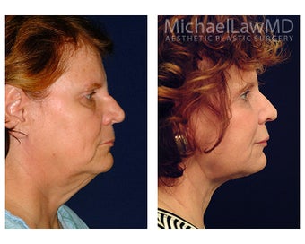Facial Rejuvenation 395143