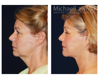Facial Rejuvenation - Neck Lift 395329