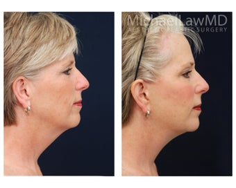 Facial Rejuvenation - Brow Lift 395401