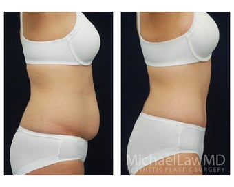 Abdominoplasty - Tummy Tuck 396063