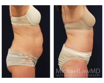 Abdominoplasty - Tummy Tuck 396111