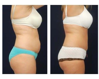 Abdominoplasty - Tummy Tuck 396151