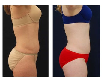 Liposuction 397085