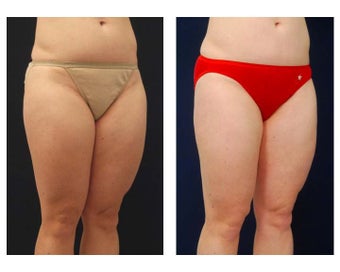 Liposuction 397096