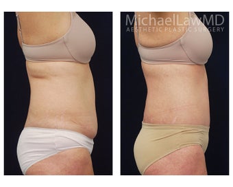 Liposuction 397121