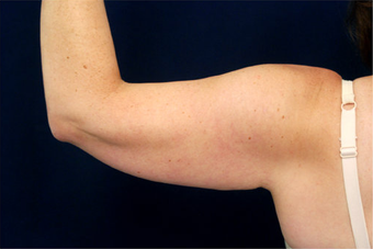 Liposuction 397146