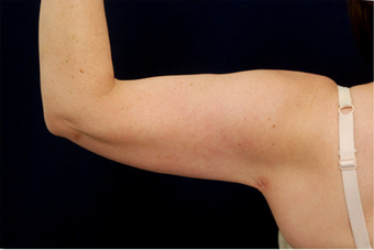 Liposuction 397146