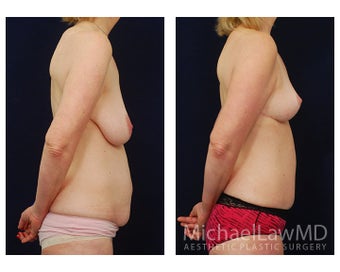 Mommy Makeover 398688