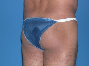 Buttock augmentation with implant 398796